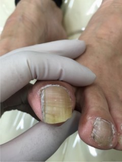 巻き爪手術